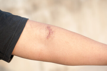 Close up of a scar on arm