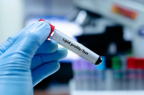 Blood sampling tube for lipid profile analysis.