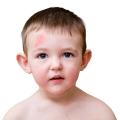 Toddler baby face with scratch on forehead, isolated on white background. Portrait of a baby boy with a head injury, isolated on white background. Kid aged one year six months