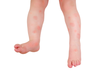 Toddler baby skin care, allergies and dermatitis, isolated on white background. Red spots of allergy and atopic dermatitis on the child skin, isolated white background. Kid aged one year eight months