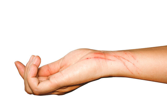 Dog nail scratch on human sales