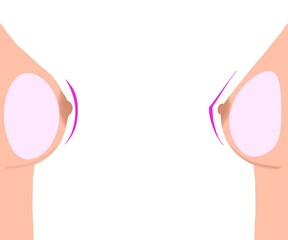 Round implant vs Teardrop implant. Breast implant shapes comparison illustration. Plastic surgery