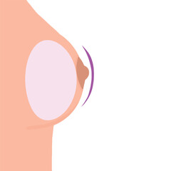 Round shape breast implant. Round silicone implant vector illustration. Plastic surgery