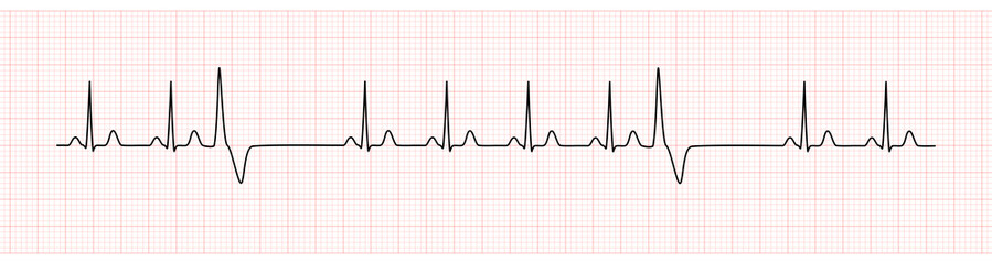 EKG Monitor Showing  Sinus Rhythm with PVC - obrazy, fototapety, plakaty