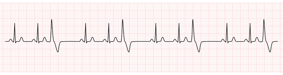 EKG Monitor Showing  Sinus Rhythm with Trigeminy PVC