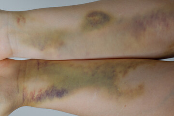 Big bruise on the woman's hands close up
