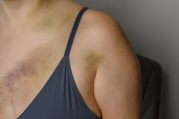 Bruise on the woman's skin close up