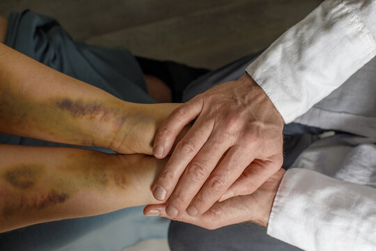Supporting victims of domestic violence. Female hand with bruises and doctor hand closeup.
