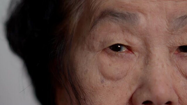 Close up of the senile cataract during eye examination. A white cloudy disc is seen in black eye circle, mature cataract, nuclear sclerosis cataract. Close up half face view