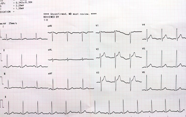 Graph showing the results of the electrocardiogram (EKG) test on recording paper.