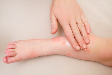 Toddler baby skin care, allergies and dermatitis. A mother woman smears red spots of allergy and...