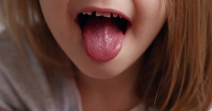Girl with scarlet fever shows a red tongue covered in pimples. concept of illness, caring for a child.