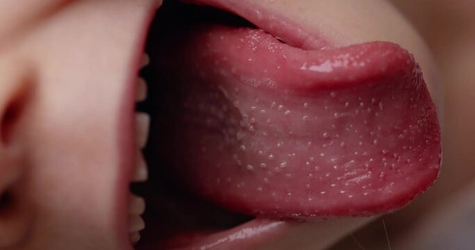 Girl with scarlet fever shows a red tongue covered in pimples. concept of illness, caring for a child. Vertical video.
