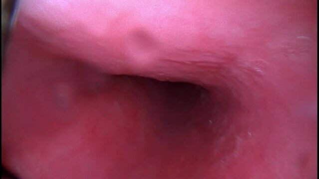 Gastroscopy examination of the gullet and stomach