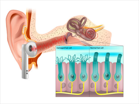 Healthy and damaged hair cells inside cochlea. Noise-induced hearing loss. Tinnitus. 