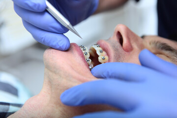 A man with metal braces on his teeth undergoing orthodontic treatment. The concept of dentistry,...