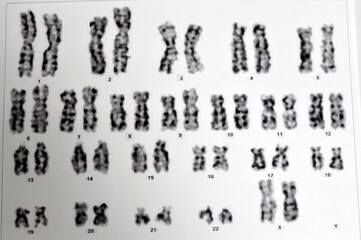 Normal female karyotyping, 46 XX, specimen collected from peripheral blood, a karyotype is the...