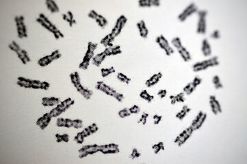 Normal female karyotyping, 46 XX, specimen collected from peripheral blood, a karyotype is the...