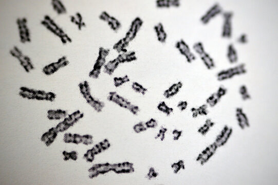 Normal female karyotyping, 46 XX, specimen collected from peripheral blood, a karyotype is the general appearance of the complete set of chromosomes in the cells of a species or in an individual organ