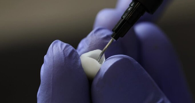 Orthopedic dentist applying glue to crown of tooth for fixation closeup 4k movie. Implantation dental prosthetics concept