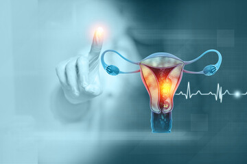 Female reproductive system diseases. Uterus cancer and endometrial malignant tumor as a uterine medical concept. 3d illustration - obrazy, fototapety, plakaty
