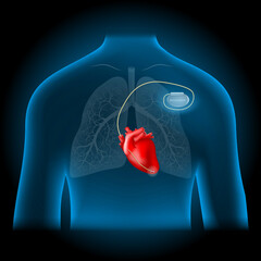 cardiac pacemaker location.