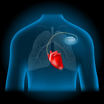 Cardiac Pacemaker Location.