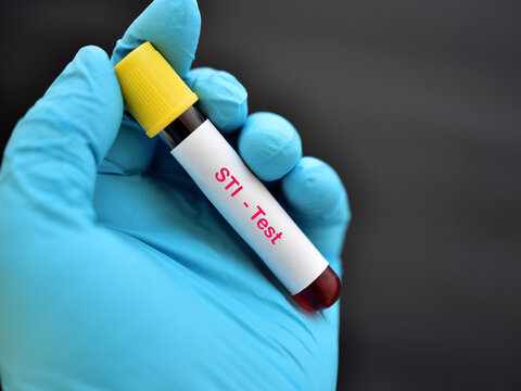 Blood Sample For Sexually Transmitted Infection (STI) Test