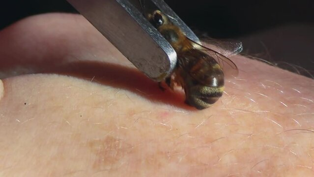 Apitherapy. With the help of tweezers, the bee is placed on the skin of a person and deliberately forced to sting. Bee stings for health and healing. Treatment of arthritis with bee venom