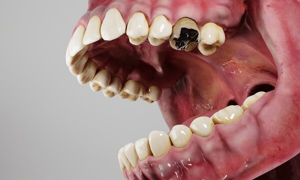 tooth decay demonstration