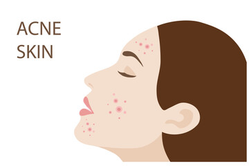 Woman face with skin acne, pimples, blackheads vector illustration. Acne skin face problem concept