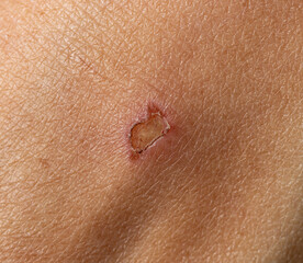 burn on hand as background.
