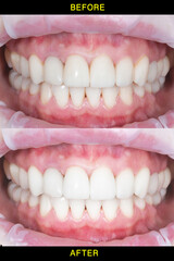 Collage for comparison. Smiling man before and after teeth whitening procedure, closeup. Collage
