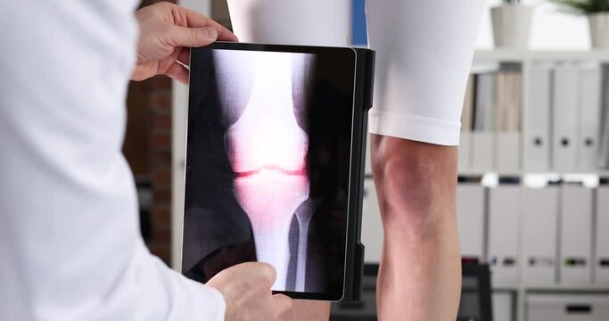 Doctor doing computer examination of knee joint using digital tablet 4k movie. X-ray diagnosis of arthritis concept