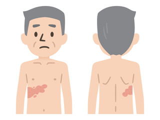 帯状疱疹の症状イラスト