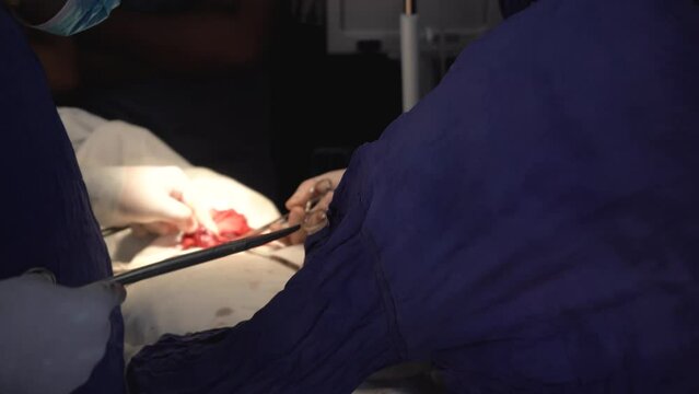 strangulating all the arteries and veins which passes to the thyroid