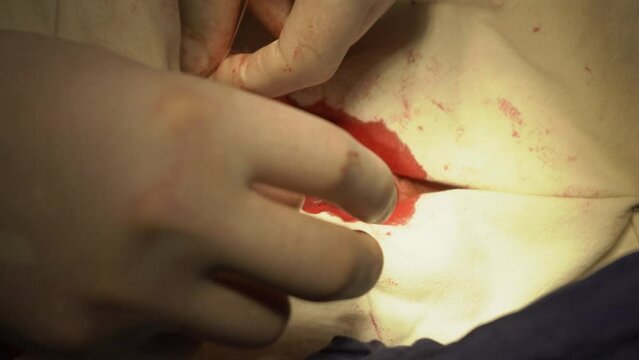 tight strangulation done by a surgical resident