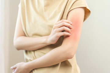 Dermatology asian young woman, girl allergy, allergic reaction from atopic, insect bites on her arm, hand in scratching itchy, itch red spot or rash of skin. Healthcare, treatment of beauty.