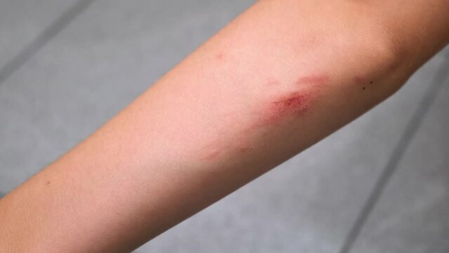Wounded elbow of the child. Abrasion on the cubit of kid close-up after the fall. A scratch with blood. Body trauma.