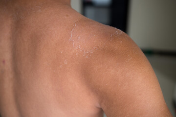 Man get sun burn with sloughs off on his shoulder