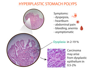 Infographic of the hyperplastic stomach polyps