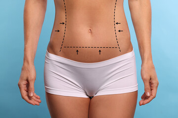 Woman with markings for cosmetic surgery on her abdomen against light blue background, closeup