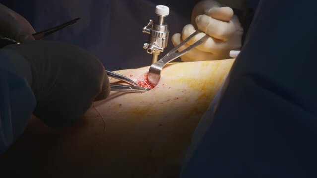 Professional surgeons in surgical suits operate patient and stitch wound after laparoscopic surgery in operating room. Medics use medical clips and thread. Medical staff at work in clinic. Close up.
