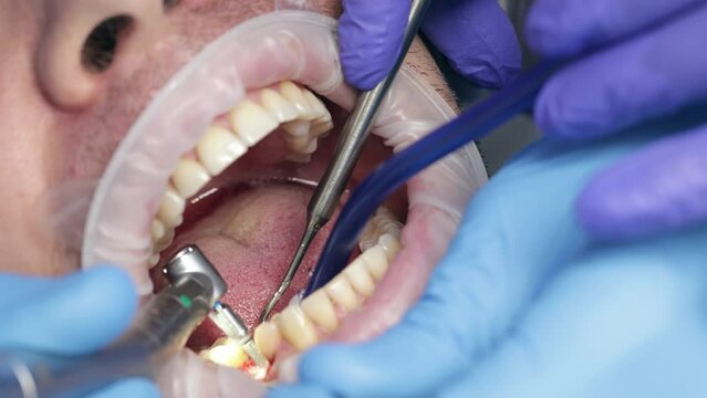 Dental tooth implantation. Dental surgeon drills the hole in the jaw bone for the implant in modern dental clinic. Dental surgery