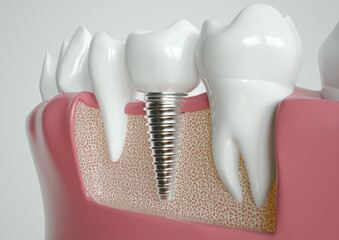 Implant Integration in Jaw Anatomy Visualization - 3D Rendering - obrazy, fototapety, plakaty