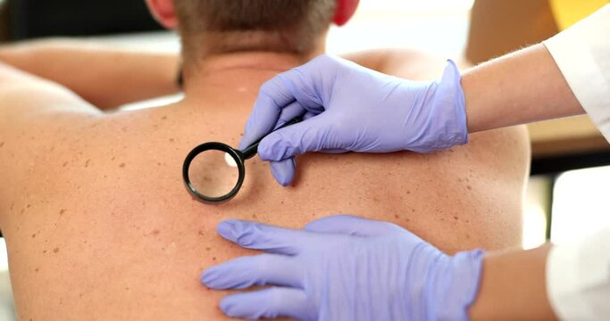 Dermatologist examines back birthmark and birthmark of patient with magnifying glass in clinic. Dermoscopy of moles and neoplasms