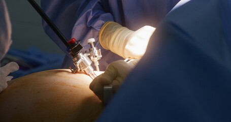 Close up of male surgeon in surgical suit operating patient using modern laparoscopic instruments...