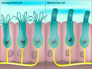 Healthy and damaged hair cells inside cochlea. Noise-induced hearing loss. Tinnitus. 
