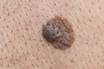 Black mole on human skin close-up