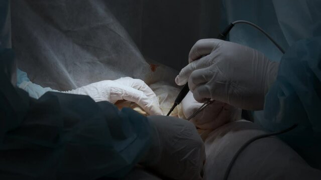 Cardiac surgeon and team perform median sternotomy. Action. Surgeon cauterizing and using professional tool.